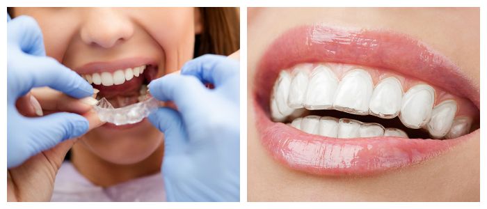Выравнивание зубов с помощью прозрачной капы