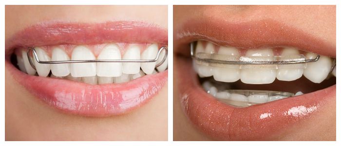 Выравнивание зубов с помощью пластин